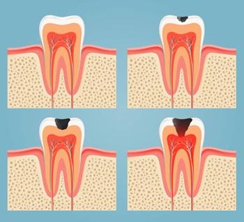 Dents cariees 2