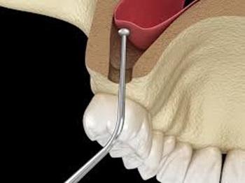 Greffe osseuse sinus 2
