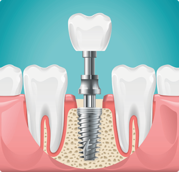 Implant 2