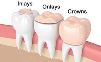 Onlay 1