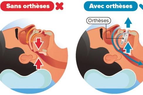 Ortheses