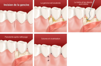 Parodontologie lambeaux removebg preview