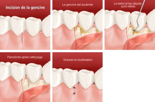 Parodontologie lambeaux removebg preview