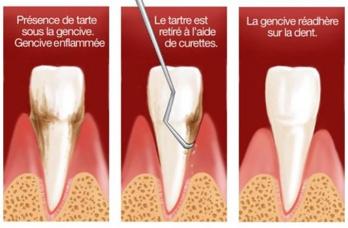 Parodontologie surfacage