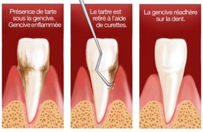 Parodontologie surfacage