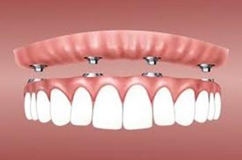 Protheses sur implant 2